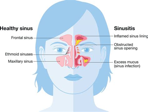 inflight sinus pressure